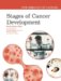 Stages of Cancer Development cover