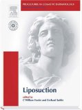 Liposuction [Click for larger image]