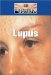 Lupus cover