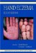 Hand Eczema cover