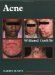 Acne cover