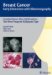 Crushed Stone-Like Calcifications : The Most Frequent Malignant Type cover