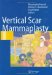  Vertical Scar Mammaplasty