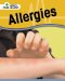  Allergies